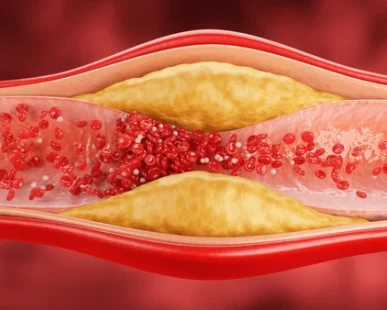 3d-illustration-narrowed-blood-vessel-600nw-2678725569-387x310 Home