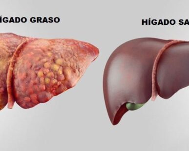 grasa-en-el-higado-387x310 Home
